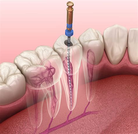 Our Root Canal Treatments The Endodontics Centre