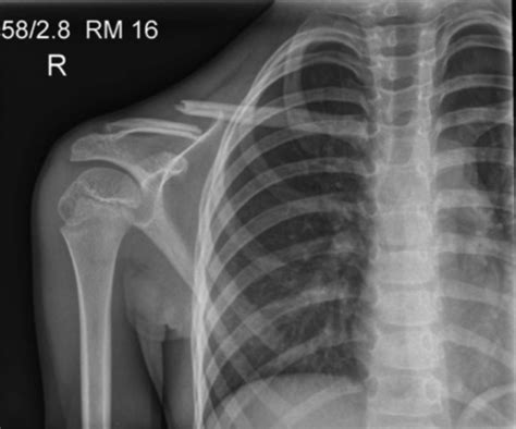 Paediatric Clavicle Fracture Oxford Trauma Flashcards Quizlet