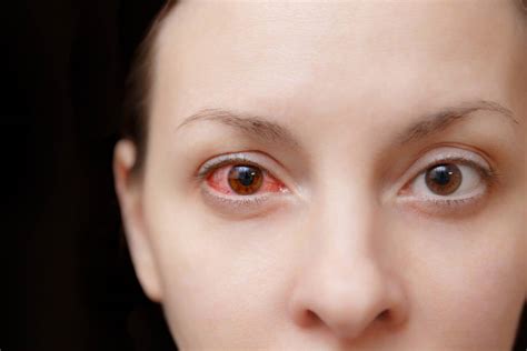 Know The Risks How Dangerous Is Sleeping With Contacts Perfectlens