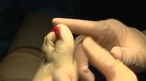 Extreme Plastic Surgery Toe Shortening For Better High Heels Look Video Abc News
