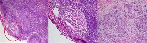 Micrometastatic Ductal Carcinoma 1 Mm Involving Sentinel Lymph Node