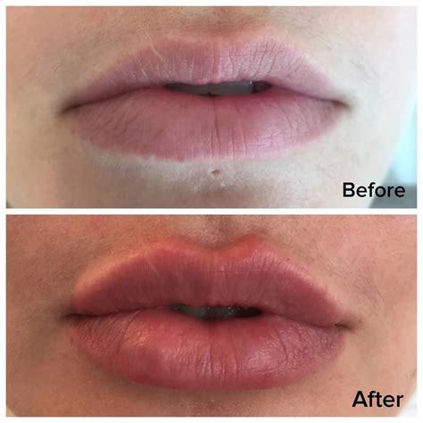 Angelina Jolie Inspired Lips Lip Augmentation Done By Jka Lipsboutiquebyjka Angelinajolielips