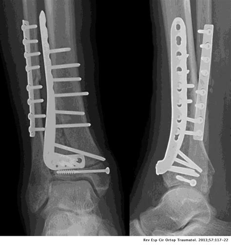 Medial Versus Lateral Plating In Distal Tibial Fractures A Prospective