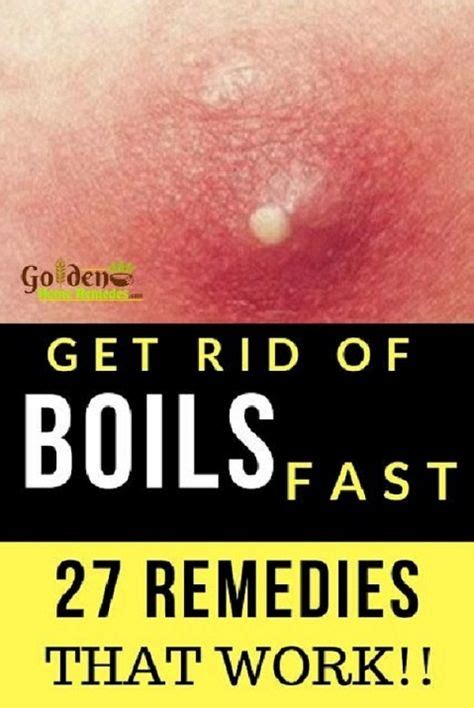 23 Getting Rid Of Boils Fast Ideas Get Rid Of Boils Home Remedy For