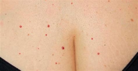 Cosa sono quei puntini rossi sulla pelle? Cosa possiamo ...