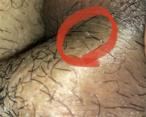 Does This Look Like Gentian Warts Should I Be Worried Penis
