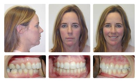 Invisalign Jaw Alignment Before And After Before And After