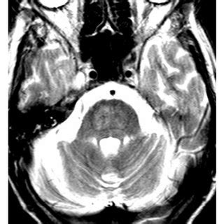 Diffusion Weighted Mri Image Of Our Patient Demonstrating Central