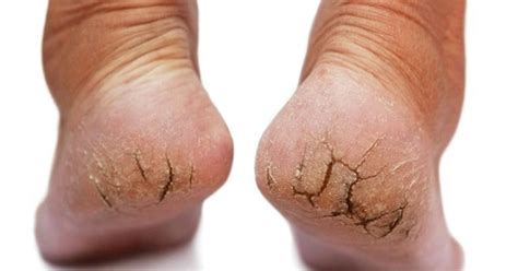 11 Of The Best Home Remedies For Dry Feet And Cracked Heels