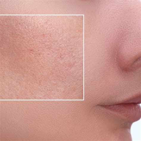 Treatment Options To Reduce Large Pores Visible Results Sc