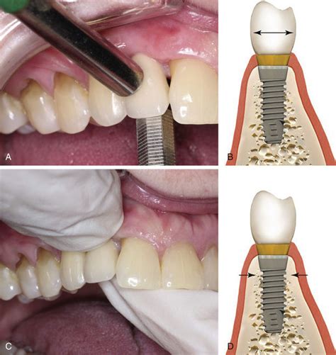 Fixed Prosthodontics Complications Pocket Dentistry