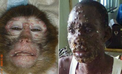 1 day ago · monkeypox is a relative of smallpox, but it's less transmissible and less deadly. The return of monkey pox, ailment that has no cure, 39 ...