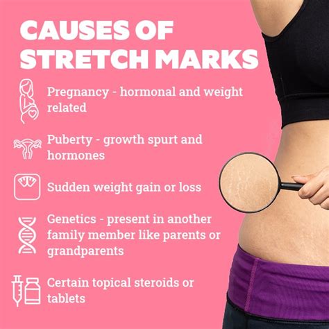 Understanding Stretch Marks Causes Variations And Treatment Options