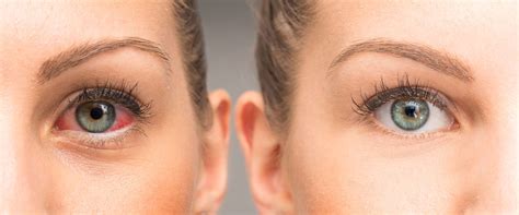 Göz kuruluğuna ne iyi gelir?