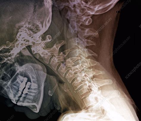 Flexion Of The Cervical Spine X Rays Stock Image C0480635