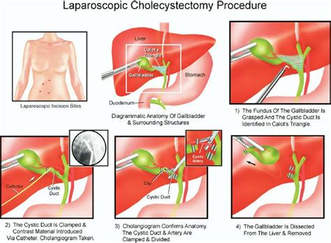 Figure A Laparoscopic Cholecystectomy With Intraoperative