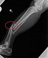 9/14右小腿脛腓骨開放性骨折 請問該如何求賠償?(有影片以及X光) (第3頁) - Mobile01