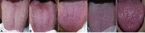 Fissured Tongue In Patients With Psoriasis Journal Of The American