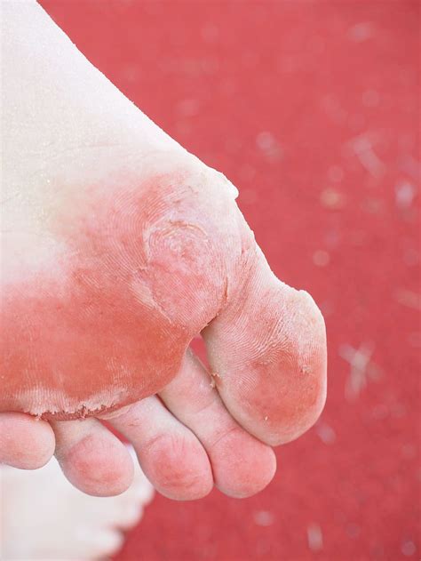 Human Skin Condition Sole Of The Foot Cornea Bubble Foot Expired