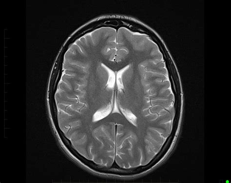 Mri Brain Scan Childs Brain Melbourne Radiology Mri At Melbourne