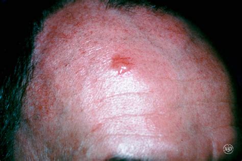 Skin Conditions That Look Like Acne But Arent Best Health Canada