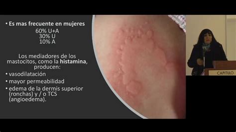 Manejo De La Urticaria Youtube