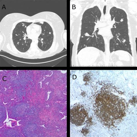 Bilateral Pulmonary Nodules In A Patient With Extensive Autoimmune