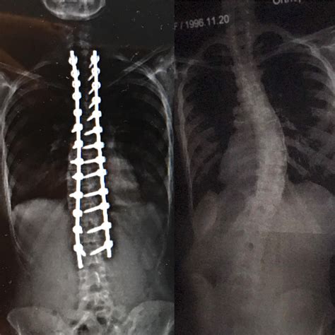 Before And After Of The Surgery I Had In May 2018 Rscoliosis