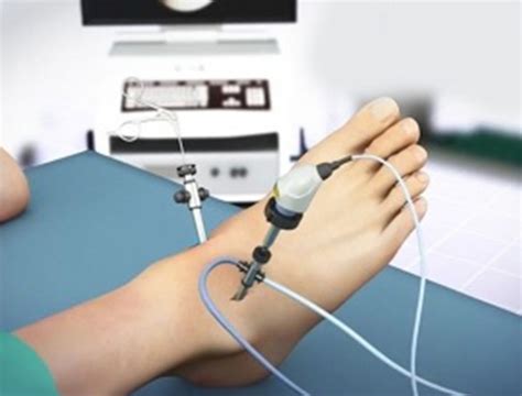 Ankle Arthroscopy London Minimally Invasive Surgery Ankle Surgeon