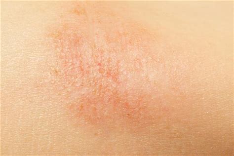 Bigstock Eczema On Child Skin 9182057 Small Dorothee Padraig South