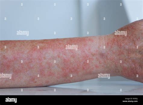 Womans Forearm Exhibiting The Itchy Rash Associated With A Severe Case