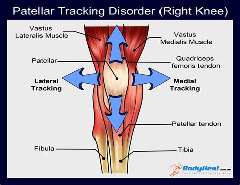 What Is Patellar Tracking Disorder Symptoms And Treatment Options Bodyheal