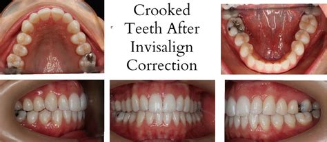 Mothlhtqqjbpqdp Invisalign Before And After Crooked Teeth