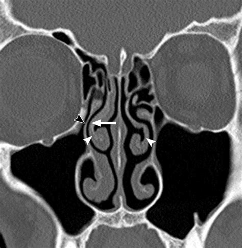 The Preoperative Sinus Ct Avoiding A “close” Call With Surgical