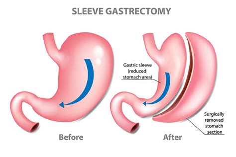 The Honest Truth About Gastric Sleeve Surgery