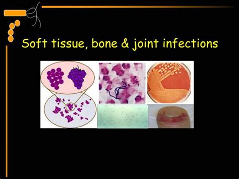 Ppt Soft Tissue Bone Joint Infections Powerpoint Presentation Free