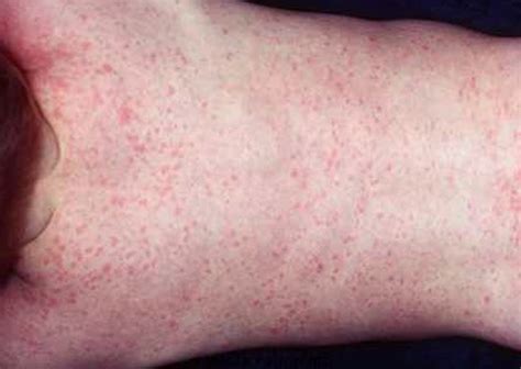 Roseola Rash Pictures Symptoms Causes Treatment Home Remedies