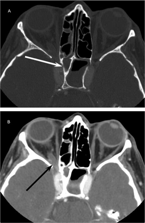 Axial Contrast Enhanced Computed Tomography Displayed On Bone Window
