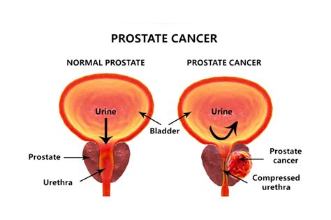 If cancer is found in a prostate biopsy, it is graded in order to estimate how fast it is likely to grow and spread. Prostate Conditions: What You Need to Be Aware Of