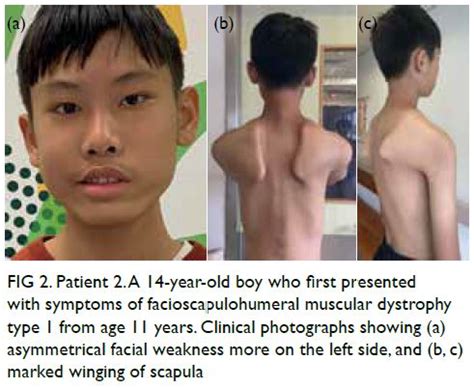 Infantile To Late Adulthood Onset Facioscapulohumeral Dystrophy Type