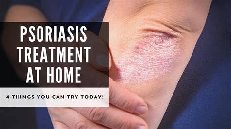 Psoriasis Treatment At Home 4 Things You Can Start Today Youtube