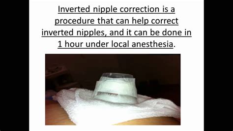 Inverted Nipple Correction Youtube