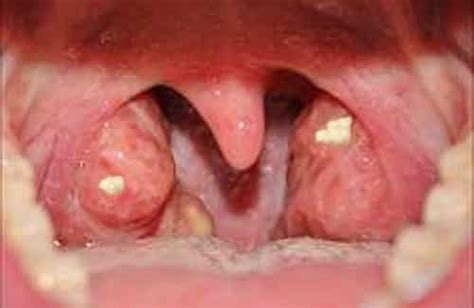 Remove Tonsil Stones Health Recovery Tips