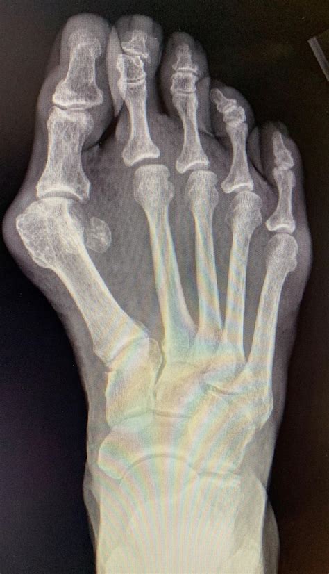 Tired Of Your Bunion Surgical Options For Correction Arizona Foot