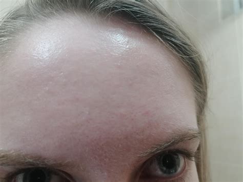 Flesh Colored Bumps On Forehead Bing Images Vrogue Co