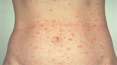 pityriasis rosea get facts on symptoms treatments and causes health digest