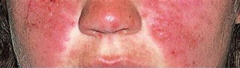 Systemic Lupus Erythematosus Concise Medical Knowledge