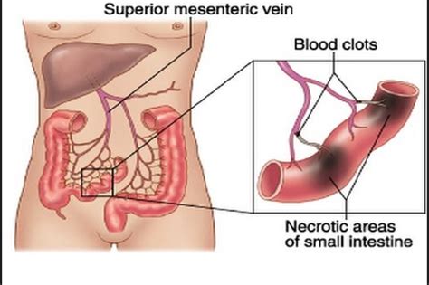 Mesenteric Artery Disease Drsrujal Shah