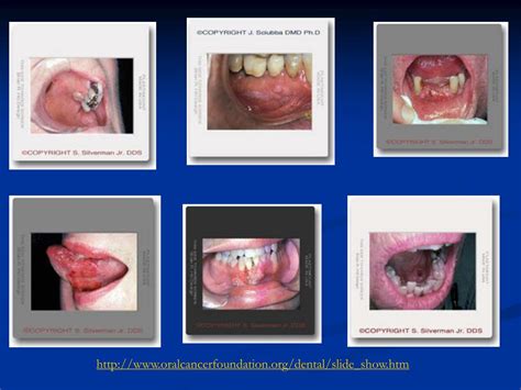 Ppt Oral Cancer Powerpoint Presentation Free Download Id5405830