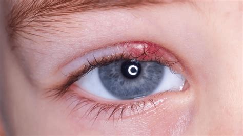 What Is An Eye Stye Causes Symptoms And Treatment
